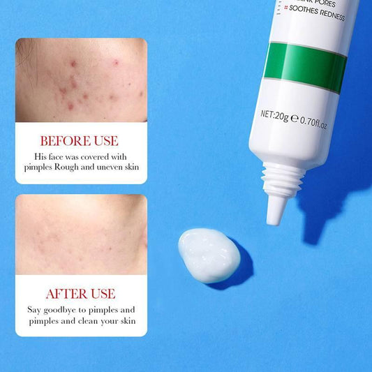 Anti acni cream